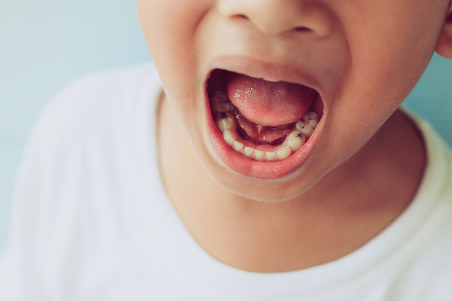 Cavities in Baby Teeth Do They Need to be Filled?